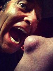 Mike and the Giant Cyst